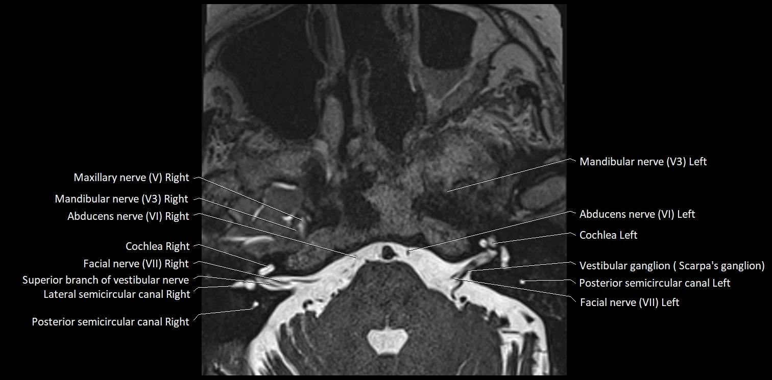 Cranial nerve anatomy axial MRI 3T image 53.webp